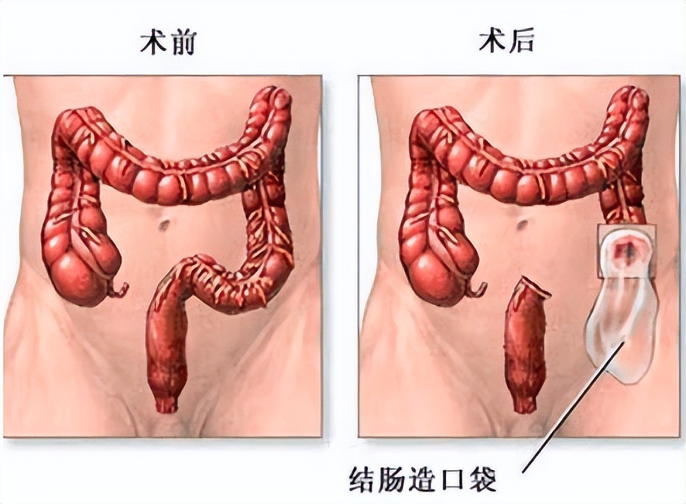 【豫健科普】大肠癌造口患者如何预防并发症？