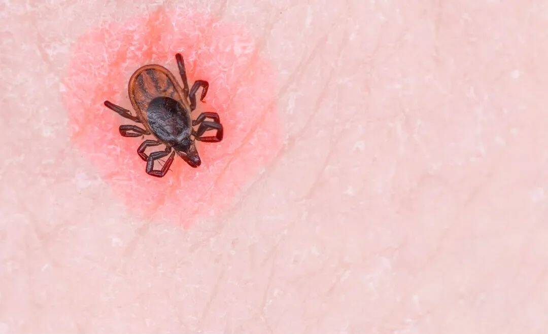 小小的蜱虫，为何能致人死亡？被咬后如何处理？