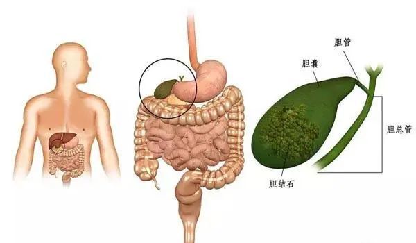 肝内胆管结石位置图图片