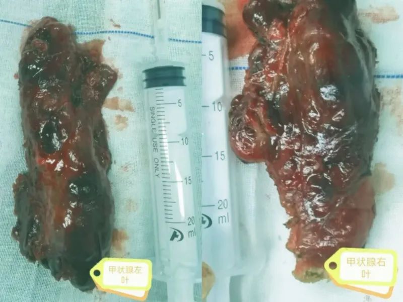 谁是胸闷气短的真正“元凶”？新区中心医院专家巧除胸骨后巨大甲状腺肿物