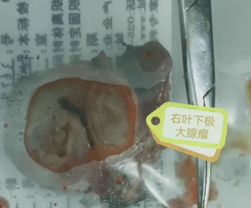 谁是胸闷气短的真正“元凶”？新区中心医院专家巧除胸骨后巨大甲状腺肿物