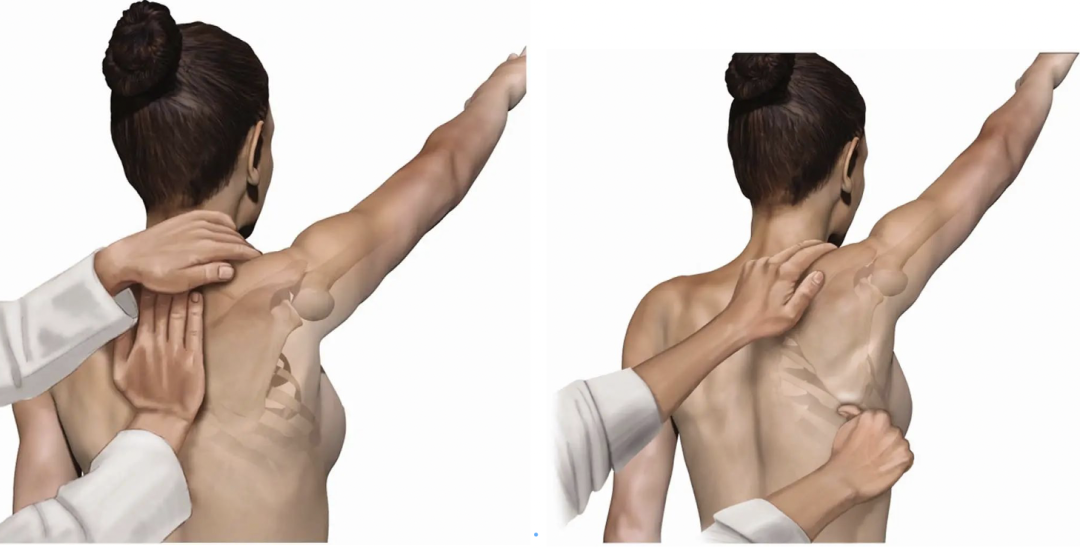 固定肩胛骨，防止内旋（左）和下移（右），疼痛减轻/肌力增加