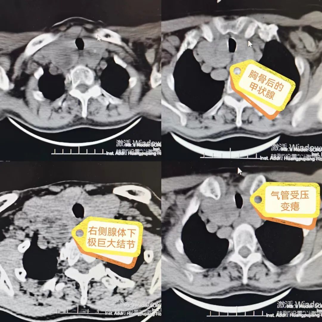 谁是胸闷气短的真正“元凶”？新区中心医院专家巧除胸骨后巨大甲状腺肿物
