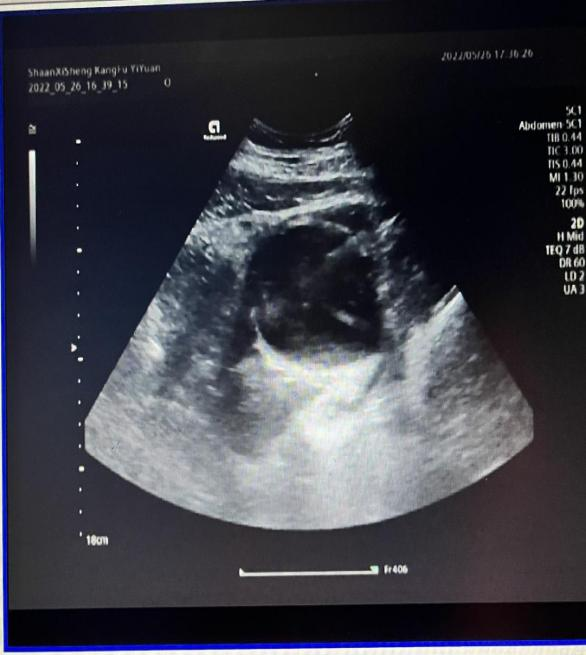 患者赵女士,34岁,于妊娠11周产检b超提示盆腔囊性包块123x114mm,得知