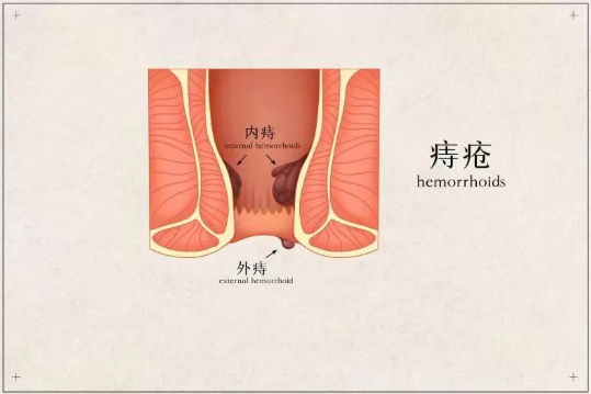 北京豐益肛腸醫院肛門處摸著有個肉疙瘩痔瘡直腸脫垂