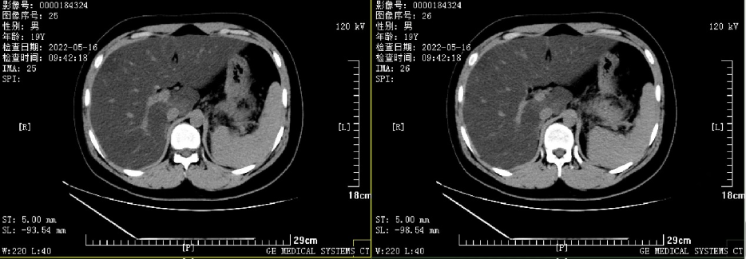 患者的腹部CT提示重度脂肪肝