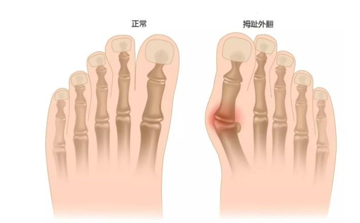 外撇,而脚大拇指的根部(实际上是第一跖骨)极为隆起,容易与鞋形成摩擦