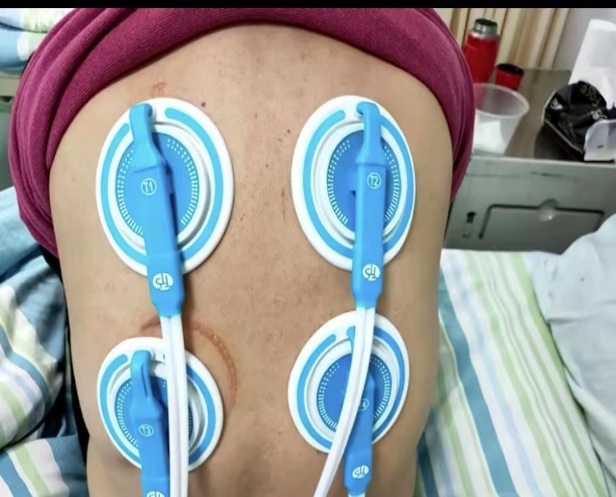 西安市胸科医院：罕见！中年男子肺里洗出17升“牛奶”