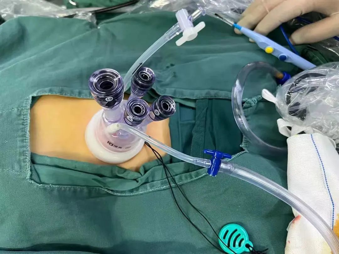 西安市儿童医院完成首例单孔3D腹腔镜下胆总管囊肿根治