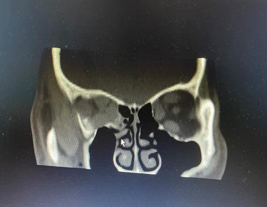 术后眼眶CT造影