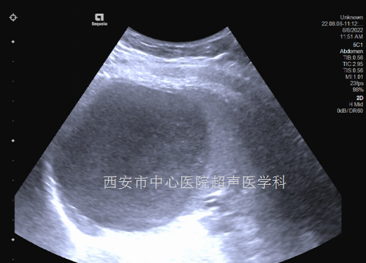 超声微创巧拆花季少女脾脏定时炸弹