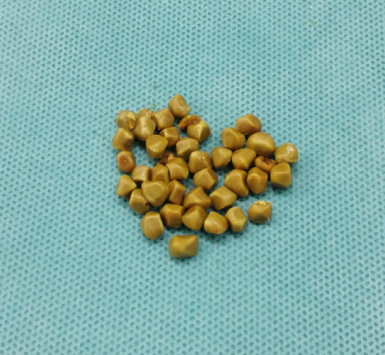 术后结石标本