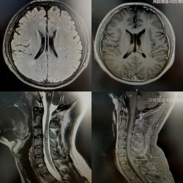 下肢麻木无力未重视 结果是脊髓病变凤凰网陕西_凤凰网