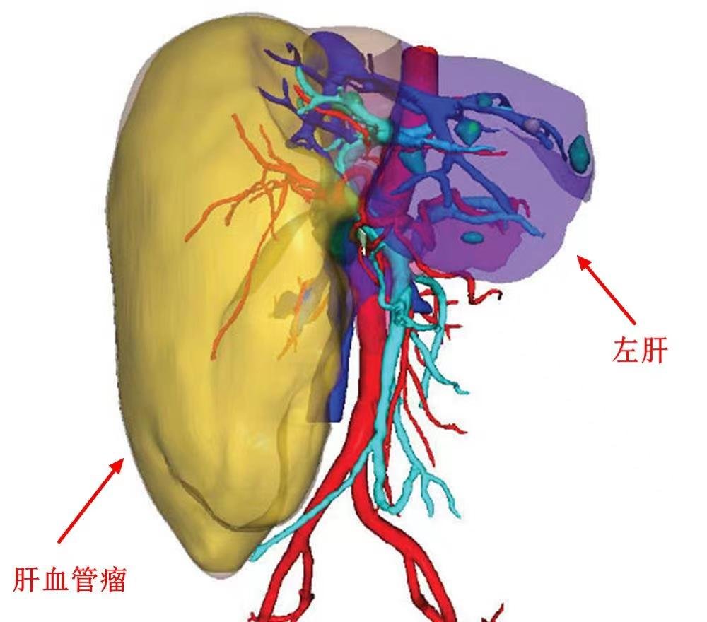 男性肝血管瘤图片