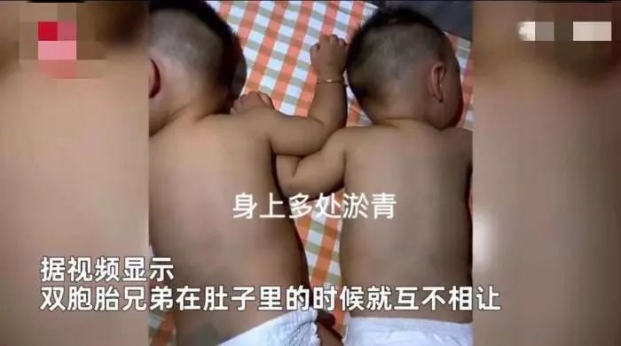 网传双胞胎出生后身上多处淤青视频截图。