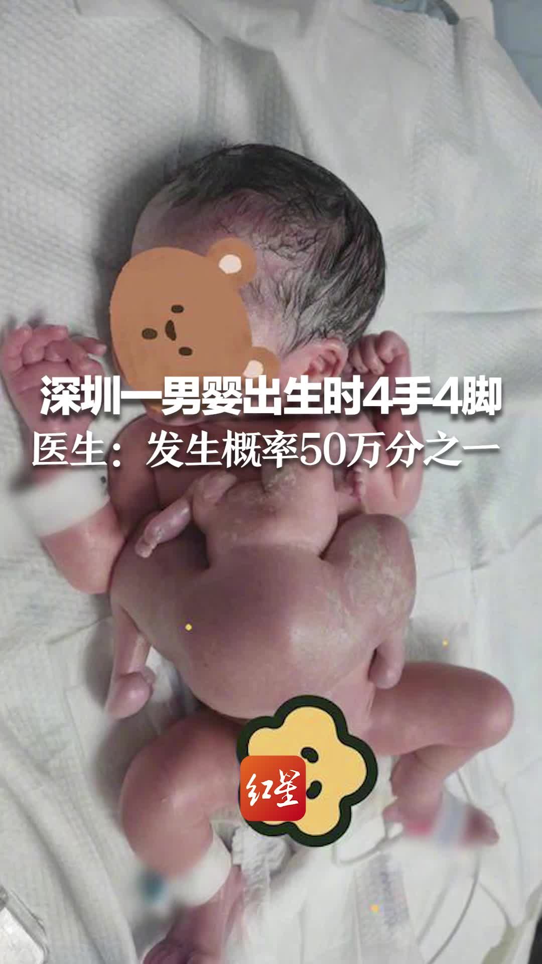 深圳一男婴出生时4手4脚 医生：发生概率50万分之一
