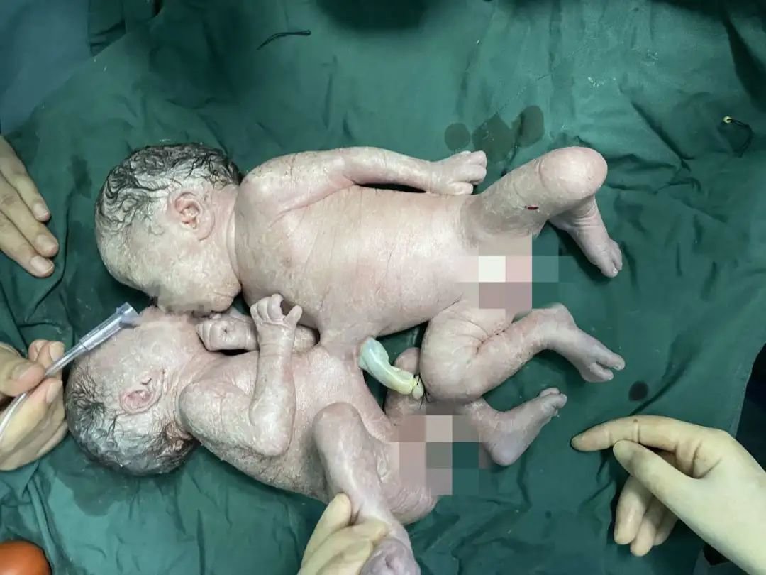 世所罕见 时隔22年再遇联体婴!姐姐妹妹在浙大儿院成功“分身”