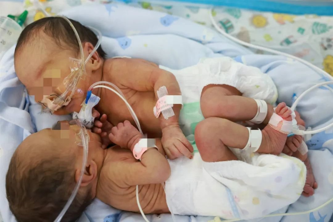 NICU中手术前的联体婴