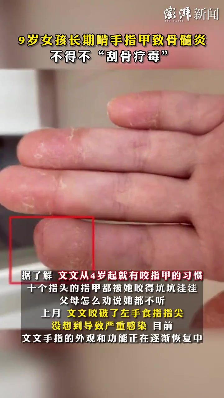 9岁女孩长期啃手指致骨髓炎，不得不“刮骨疗毒”