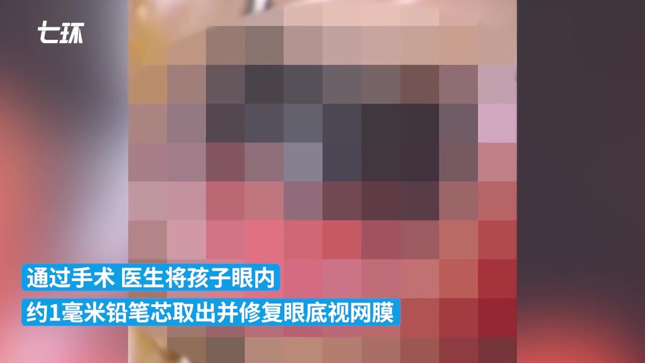 4岁女童玩耍时将铅笔扎入眼睛，致永久视力损伤