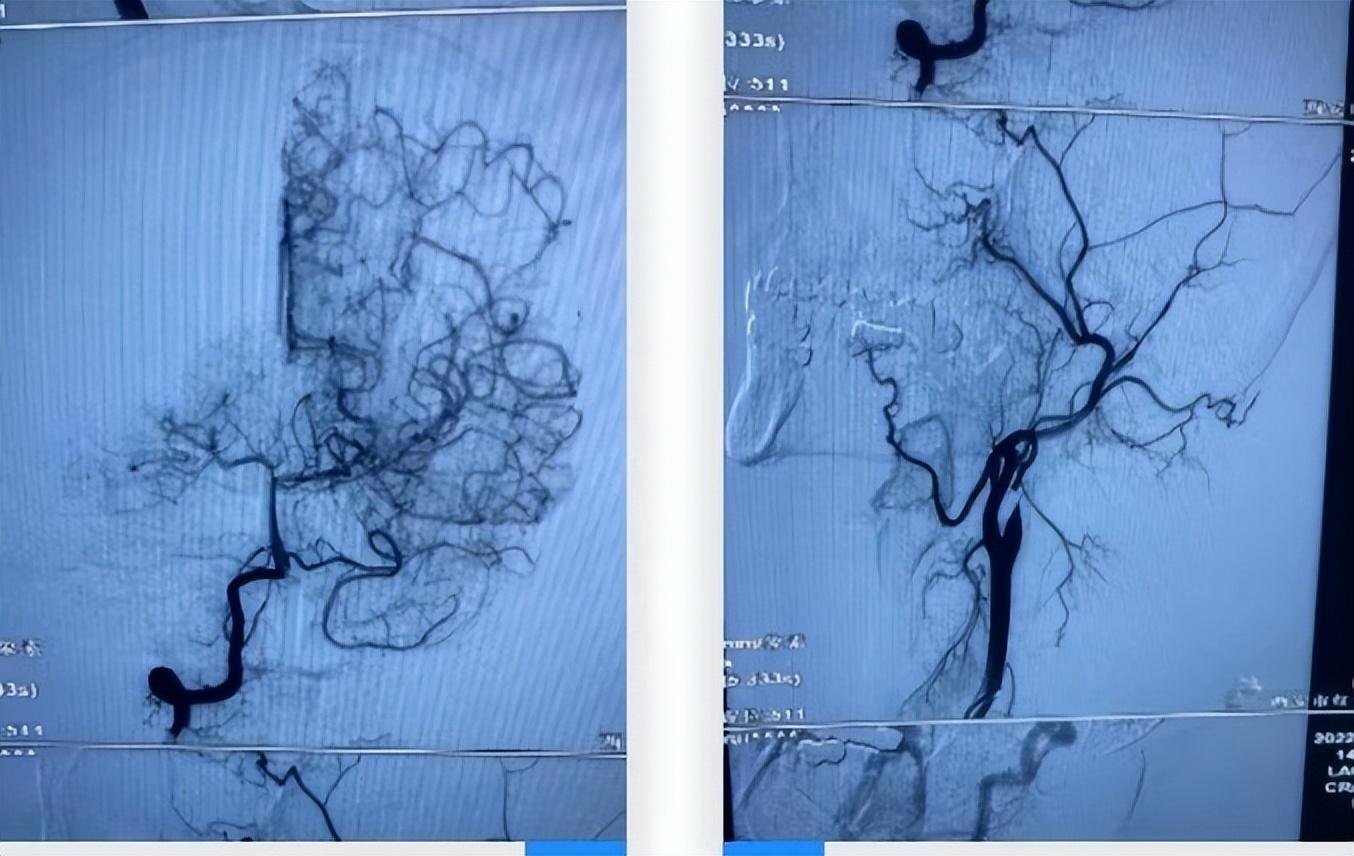脑血管造影提示左侧颈内动脉仅剩一残端显影