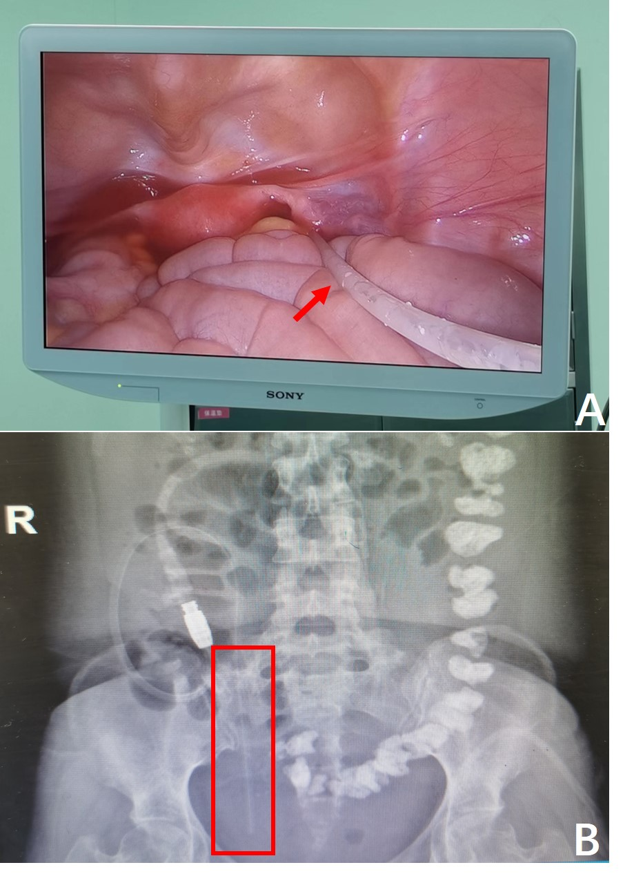 术后腹部立位片可见腹透导管位于小骨盆腹膜透析和血液透析是目前应用