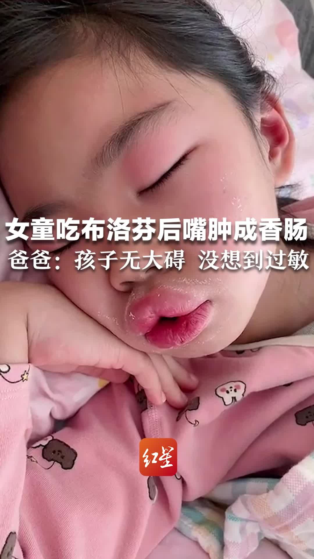 女童吃布洛芬后嘴肿成香肠,爸爸:孩子无大碍 没想到过敏