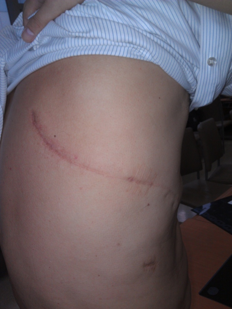 图1 开胸手术切口长约30cm