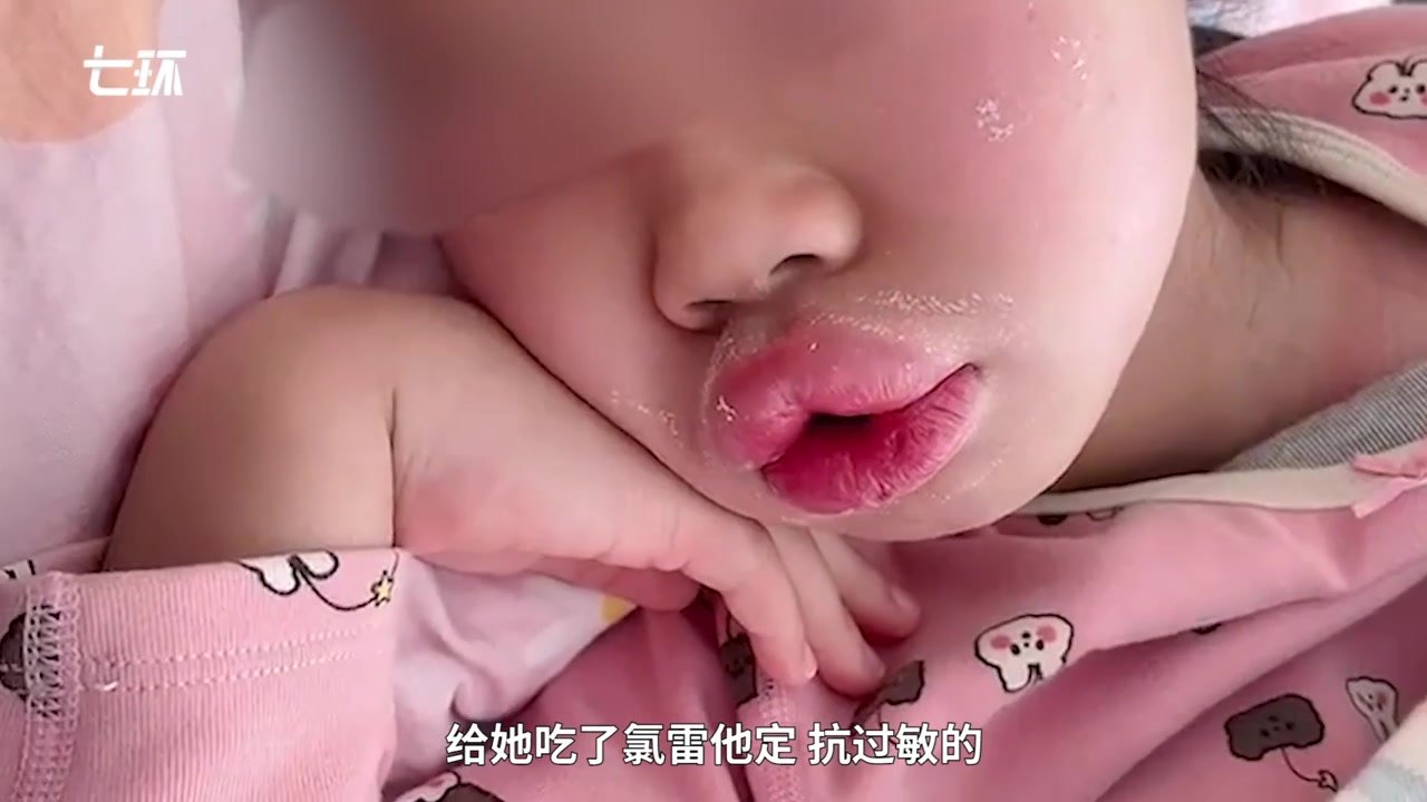 女孩过敏肿成“香肠嘴”，爸爸：吃的布洛芬，不知道会过敏