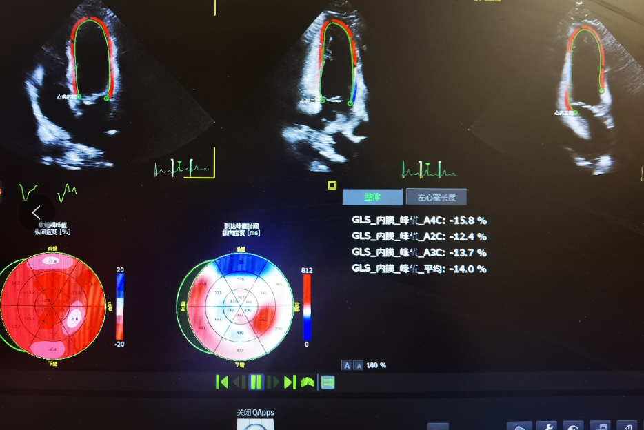 南医大二附院心超新技术助力发现早期病毒性心肌炎