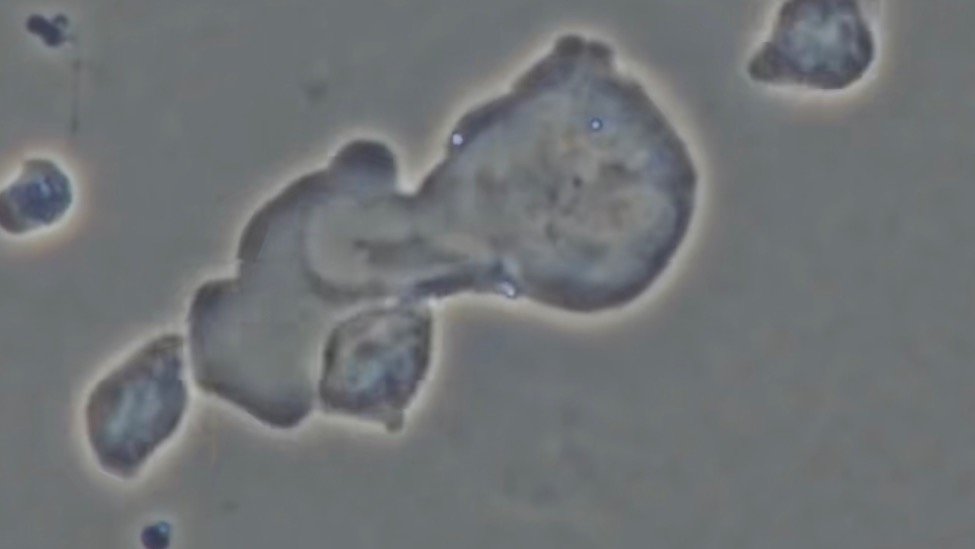 显微镜下看自然杀伤细胞怎么把癌细胞击碎