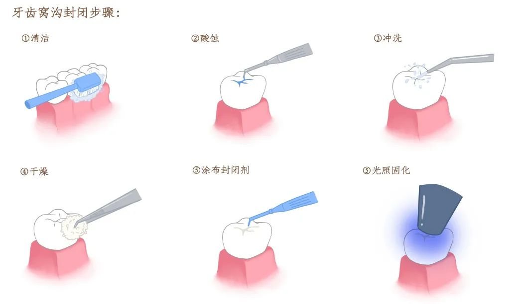 家长必看 | 终身不换的“六龄牙”,如何保护?