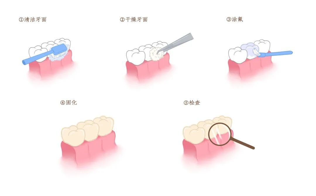 家长必看 | 终身不换的“六龄牙”,如何保护?