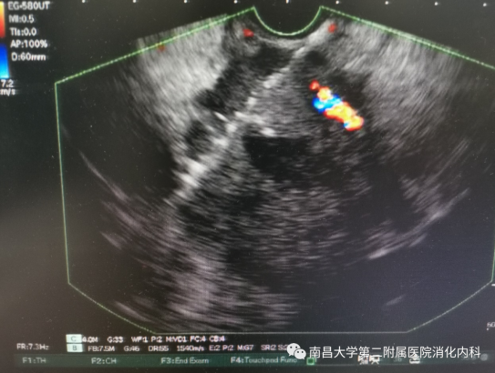 超声内镜引导下肿瘤内碘125粒子植入