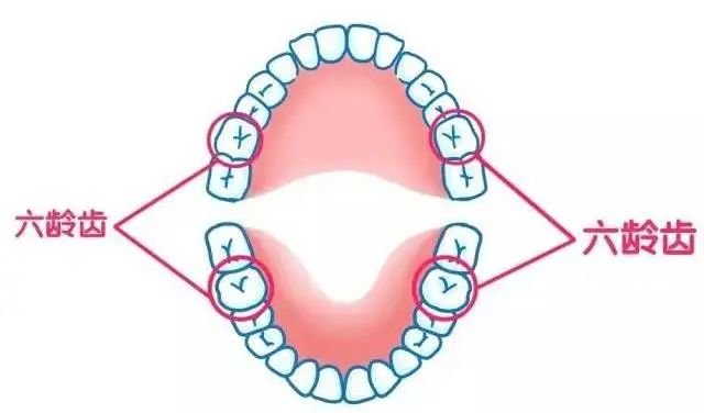 家长必看 | 终身不换的“六龄牙”,如何保护?