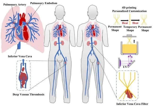 4D打印形状记忆IVCF微创治疗PE的设计示意图