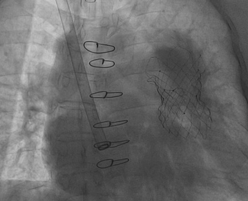 患者术后肺动脉瓣反流得到显著改善