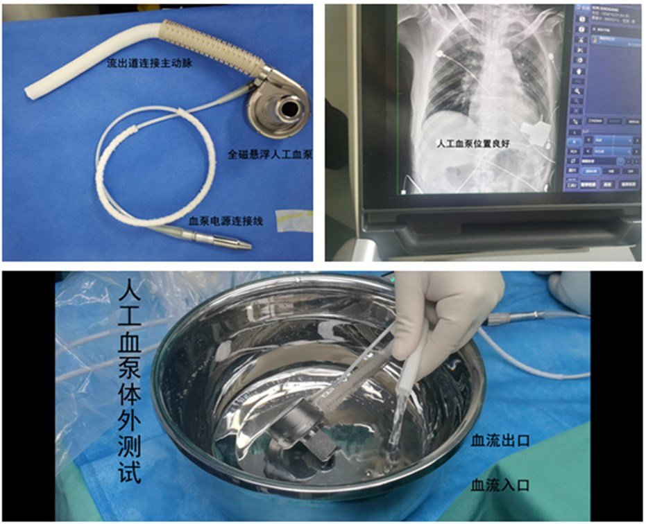 西北首例！六旬患者变身国产“钢铁侠”重获“心”生