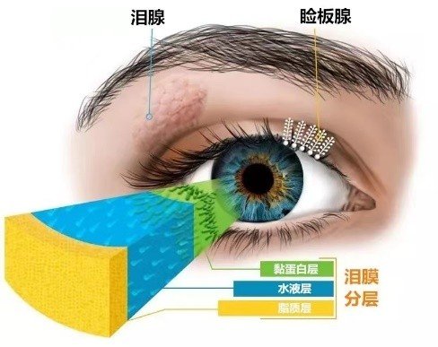 睑板腺堵塞了怎么办？轻度干眼症可以自愈吗？人工泪液眼药水哪个牌子好？