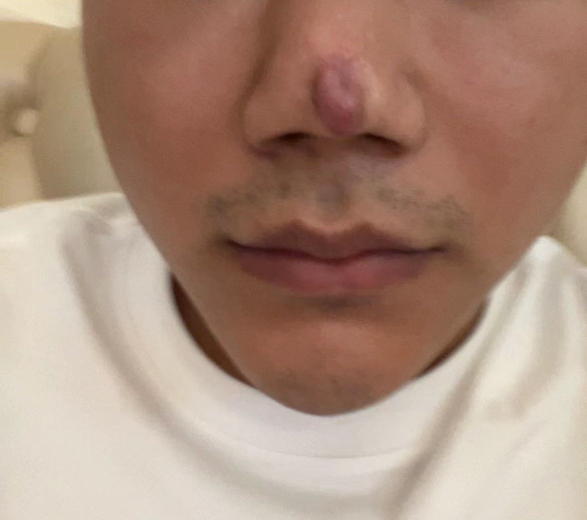△术后的陈先生，鼻子上面红肿、留疤