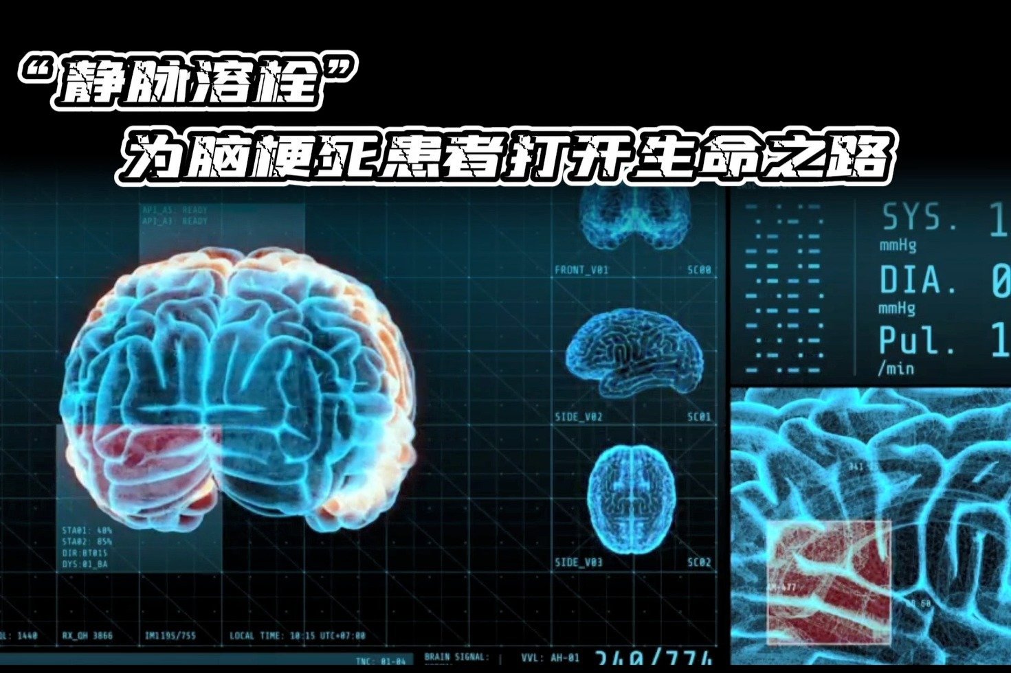 静脉溶栓治疗，为脑梗死患者打开生命之路