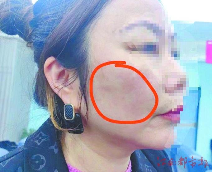 胡女士脸颊凹凸不平