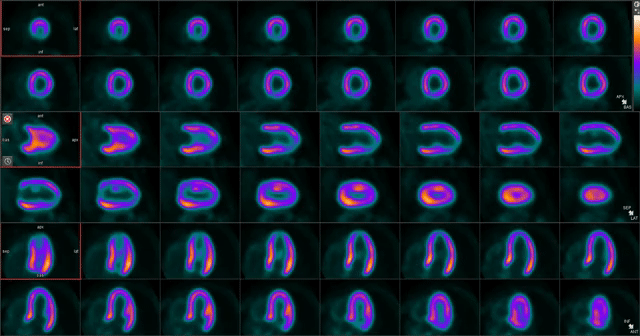 Vereos PET/CT高清心肌显像