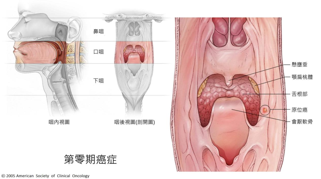 ▎ 图/咽部是喉咙的一部分，从鼻后部到食道，食物和空气通过。除了负责维持生命所必需的功能（例如进食和呼吸）之外，它还是一个极其重要的器官，因为它还负责对社交生活很重要的声音交流。口咽分为上、中、下三部分，张口时对应末端的部分称为口咽。口咽癌是一种比较少见的癌症。据美国癌症协会的数据，美国每年约有 53,000 人患上口咽癌。早期喉癌治愈较高,但易复发。