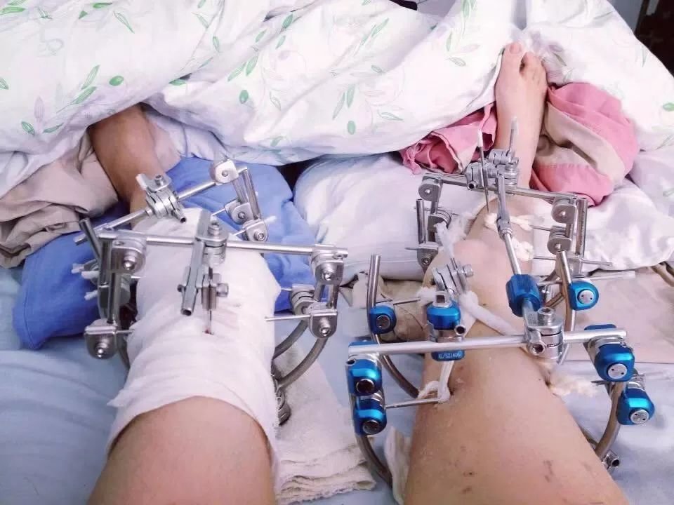 穿过双腿的克式钉