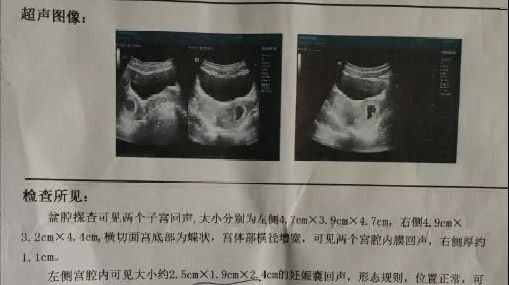 罕见！妊娠合并双子宫、双宫颈、双阴道_凤凰网健康_凤凰网