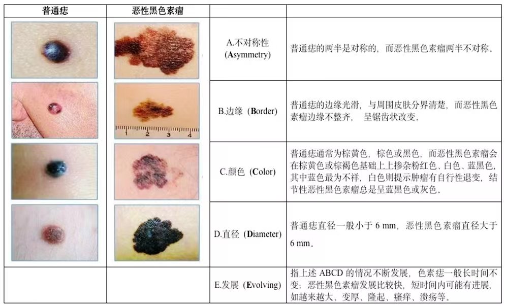 “好声音”张恒远因病去世 “黑色素瘤”究竟是什么？