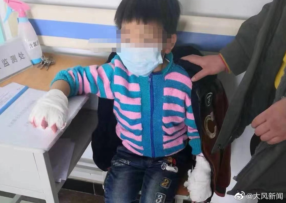 父亲称7岁女儿手被按进滚水 遭继母虐待致残