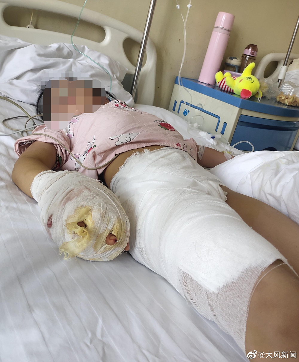 父亲称7岁女儿手被按进滚水 遭继母虐待致残
