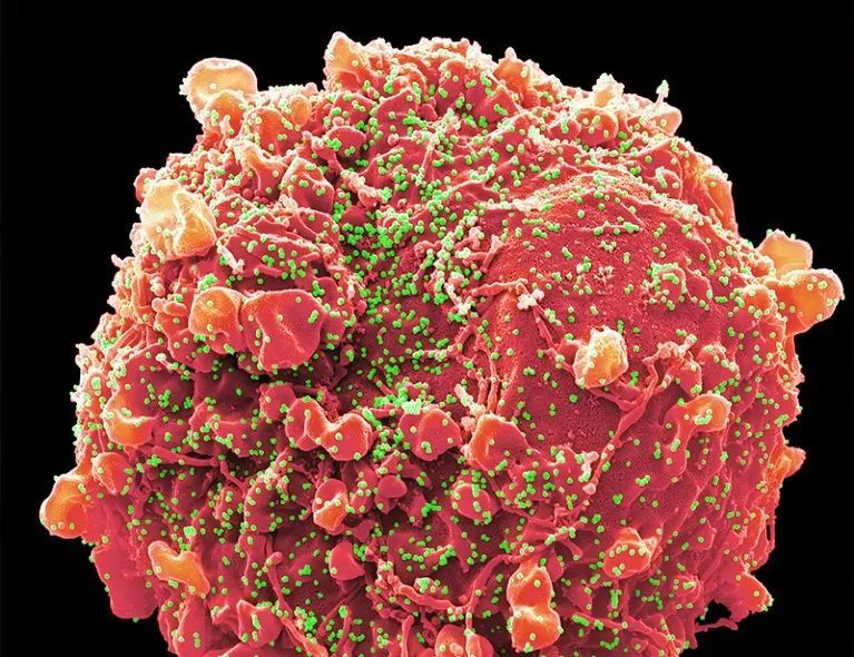 一个受感染肾细胞表面的新冠病毒（绿色）颗粒。来源：Steve Gschmeissner / Science Photo Library